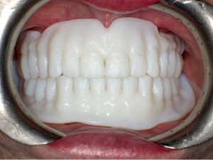 FIGURE 14. Try in dentures to evaluate fit, retention, stability, support, contour, lip support, aesthetics and vertical dimension of occlusion.