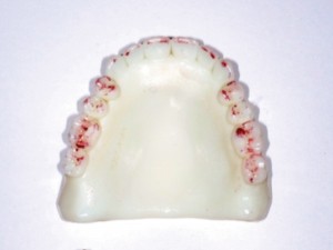 FIGURE 15. Try in dentures to evaluate fit, retention, stability, support, contour, lip support, aesthetics and vertical dimension of occlusion.