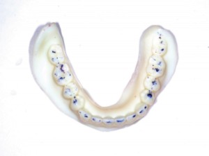 FIGURE 16. Mandibular try in denture to refine denture balanced occlusion.