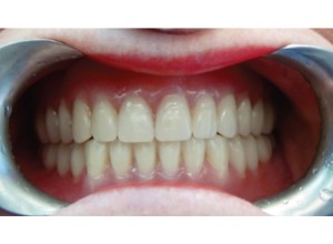 FIGURE 18. Initial insertion of maxillary and mandibular complete dentures by third appointment.