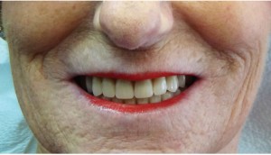 FIGURE 19. Satisfied patient with digital dentures providing retention, stability, support, aesthetics and functional occlusion.