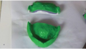 FIGURE 7. Sectioning the maxillary final impression in preparation for jaw relations record.