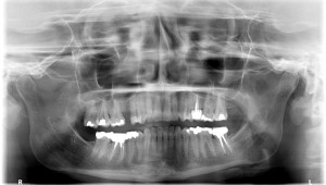 FIGURE 5. Patient Panoramic X-ray prior to the treatment