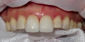  FIGURE 11. Porcelain veneers of the maxillary central incisors were first cemented in place with a light-polymerized resin cement.