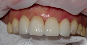 FIGURE 12. Veneers for the laterals were then cemented.