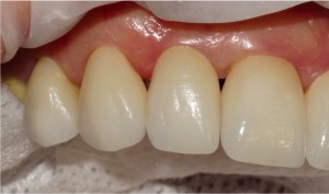  FIGURE 14. Right side view showing porcelain veneers on central, lateral, canine and first premolar in place.