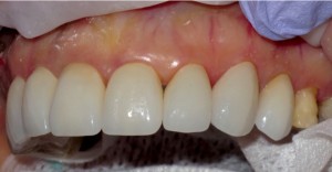 FIGURE 15. Left side view showing porcelain veneers on central, lateral, canine and first premolar in place.