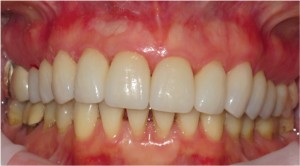 FIGURE 16. Frontal view showing all nine porcelain veneers cemented in place in addition to the porcelain crown cemented on tooth 15.