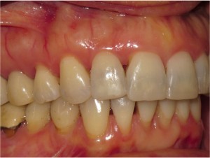  FIGURE 2. Preoperative appearance of the right anterior side.