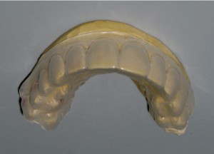 FIGURE 5. A clear matrix was made in a vacuum-forming machine on the waxed up model for fabrication of provisional veneers.