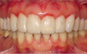 FIGURE 6. Provisional restorations were made using a clear matrix made to a waxed-up model. Spot bonding at the centers of the vestibular surfaces of the premolars was followed to optimize retention.