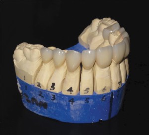 FIGURE 7. Nine porcelain veneers and one porcelain crown were fabricated at a dental laboratory.