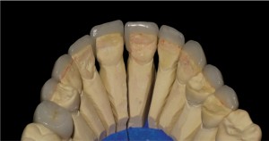 FIGURE 8. Lingual aspect of the fabricated porcelain restorations.