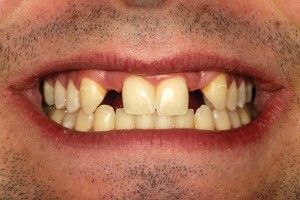 FIGURE 2. A preoperative full smile view showing missing maxillary incisors after removal of the “provisional” aligner.