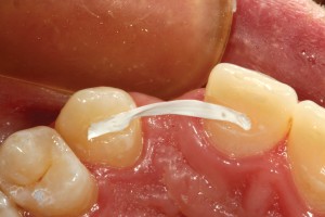 FIGURE 3. A piece of dental floss is used to measure the arch length from the distal portions of each “slot” to determine the length of fiber reinforcement that will be used.