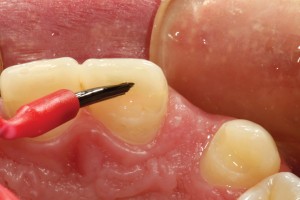  FIGURE 5. Bonding agent is brushed into the preparations, air thinned, then lite cured.