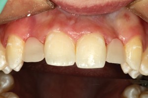 FIGURE 10. A facial view of the “pontics” in the tooth 12 and 22 positions formed on both the labial and palatal aspects of the fiber using an opaque shade of composite.