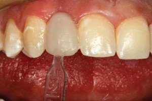 Using a preformed labial template, the facial enamel portion of the pontics are placed and lite cured. The template allows the dentist to accurately form an anatomically correct facial surface without depending on rotary instrumentation and artistic ability to determine the final restorative outcome.