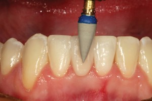 FIGURE 13.Polishing the facial surface with a composite polishing point.