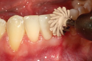 FIGURE 14. Polishing proximal and cervical contours with a rubber composite polisher.