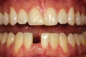 FIGURE 18. A retracted preoperative facial view of a patient with a missing mandibular right central incisor.