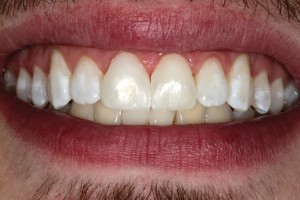 FIGURE 21.This post operative full smile photograph shows how beautifully aesthetic the direct composite fiber reinforced bridge can be as well as being a expedient, one visit restoration for the patient.