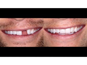 Full Natural Smile – frontal view – 1:2 magnification – before and after