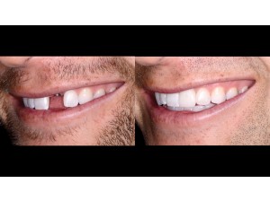 Full Natural Smile – left lateral view – 1:2 magnification – before and after