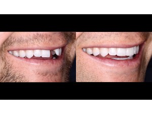 Full Natural Smile – right lateral view – 1:2 magnification – before and after