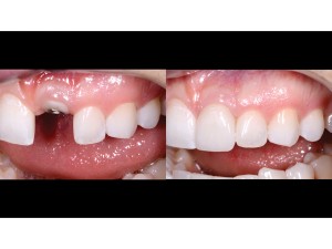 Maxillary anterior in view only – left lateral view – 1:1 magnification – before and after