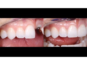 Maxillary anterior in view only – right lateral view – 1:1 magnification – before and after