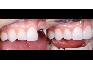 Maxillary anterior in view only – right lateral view – 1:1 magnification – before and after 