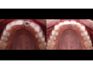 Maxillary arch – occlusal view – 1:2 magnification – before and after