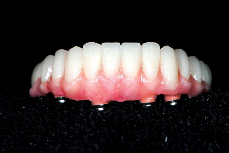 Naran Fig 29 Polished Dentures Oral Health Group