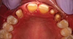 FIGURE 7. Tooth preparations.