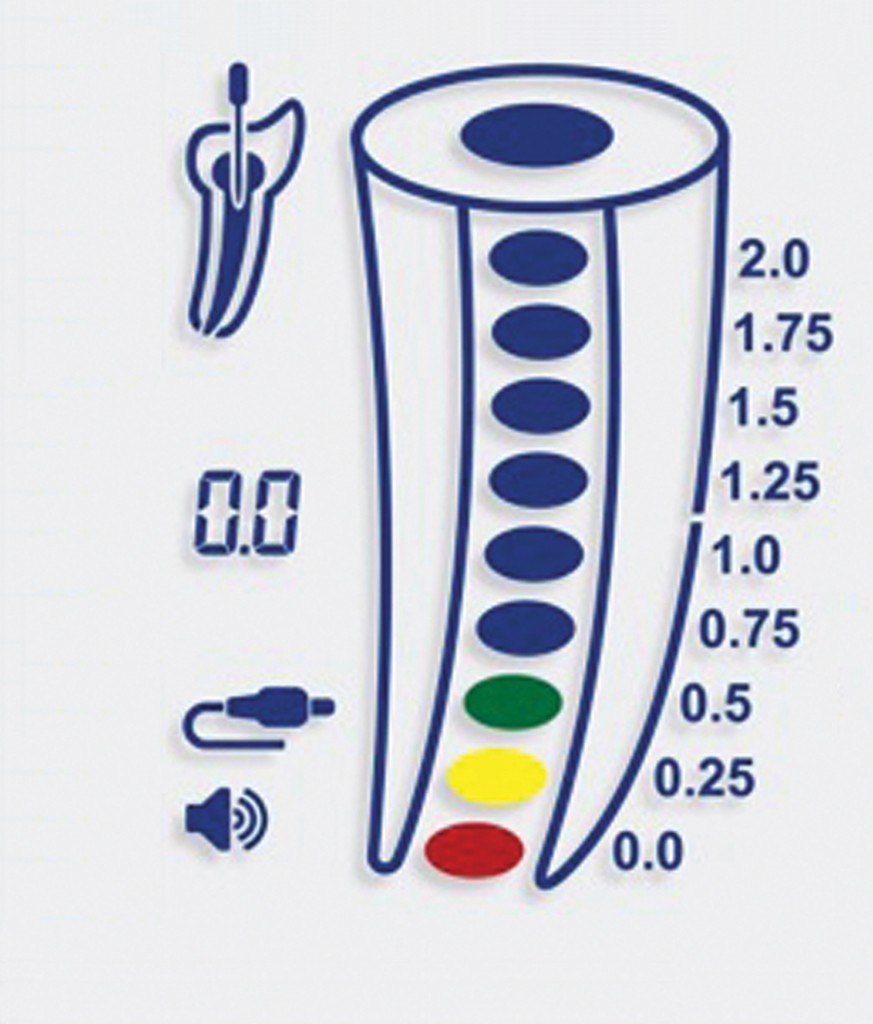 Know Your Apical Limit The Value of Modern Apex Locators in the