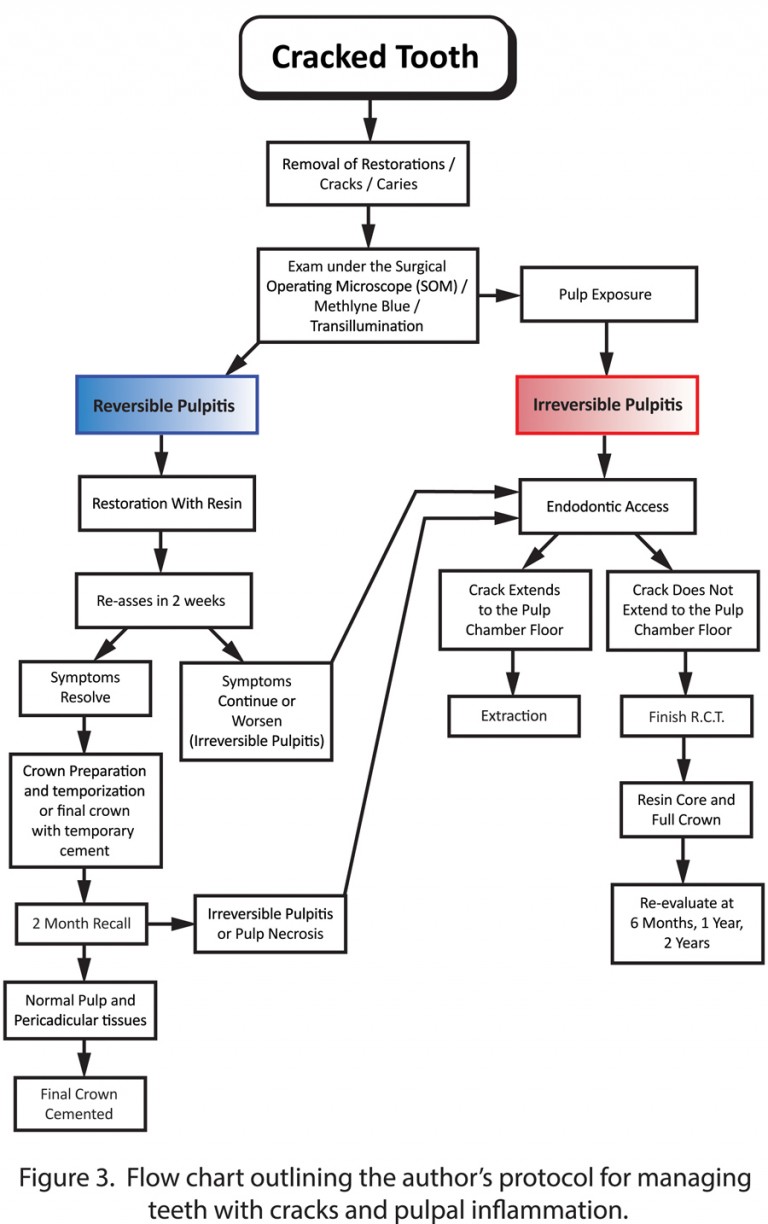 The Cracked Tooth Diagnosis and Management Oral Health Group