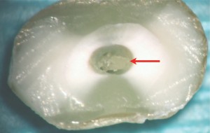 FIGURE 4. Model cross-sections of the root canals prepared using Revo-S rotary system: a) clean canal, b) canal polluted with pulp remains.