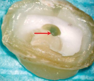 FIGURE 6.  Model cross-sections of the root canals prepared using Twisted Files Adaptive instruments: a) clean canal, b) canal polluted with dentin filings.