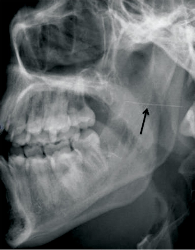 Needle Fracture During Inferior Alveolar Nerve Block A Case Report of