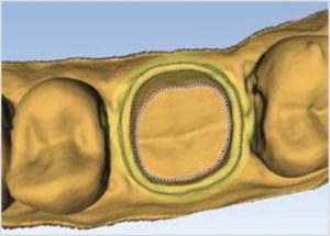 Rusanen figure 2A For assessment of the preparations, each tooth preparation was scanned with a digital scanner and the data analyzed using E4D Compare software to compare it to an ideal known preparation