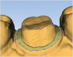 Rusanen figure 2B For assessment of the preparations, each tooth preparation was scanned with a digital scanner and the data analyzed using E4D Compare software to compare it to an ideal known preparation