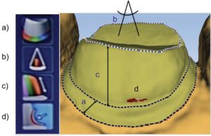 Rusanen figure 2c For assessment of the preparations, each tooth preparation was scanned with a digital scanner and the data analyzed using E4D Compare software to compare it to an ideal known preparation