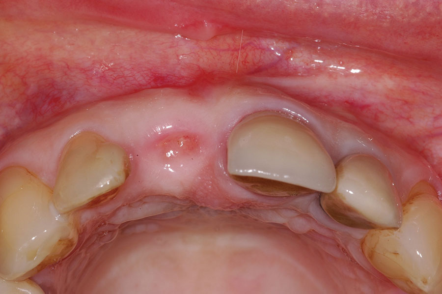 An Updated Approach to Ridge Preservation - Oral Health Group