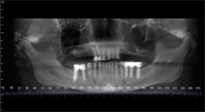 CBCT scan taken on consultation, bone loss can be seen on both sinus life sites.