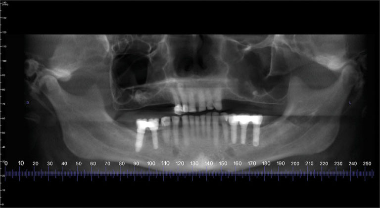 CAD-CAM Surgical Guides for Implantology: The New, The Old and The ...