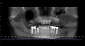 CBCT scan taken after sinus lift on the left side. (Please note that the unseated healing abutment was replaced after the scan.)