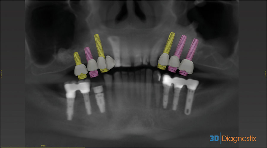 CAD-CAM Surgical Guides for Implantology: The New, The Old and The ...