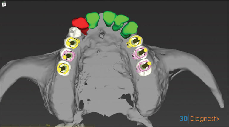 CAD-CAM Surgical Guides for Implantology: The New, The Old and The ...