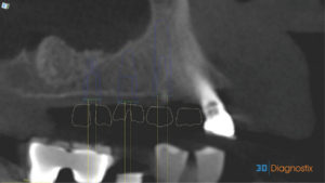 Close-up sectional view of the left side with sinus lifted site allowing longer implants selection for maximum initial stability in low-density recently grafted bone.